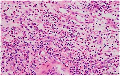 Improvement of eosinophilic chronic rhinosinusitis after infection with severe acute respiratory syndrome corona virus 2 during dupilumab therapy: A case report